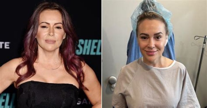 Alyssa Milano Plastic Surgery Before and After