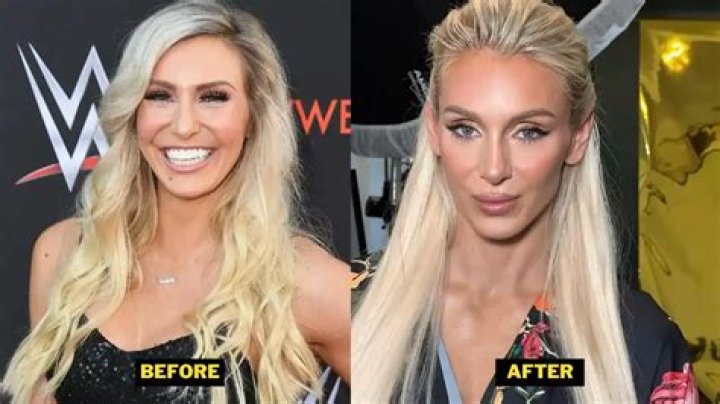Charlotte Flair Plastic Surgery: Know the Cause Behind Charlotte's Absence from The Show!