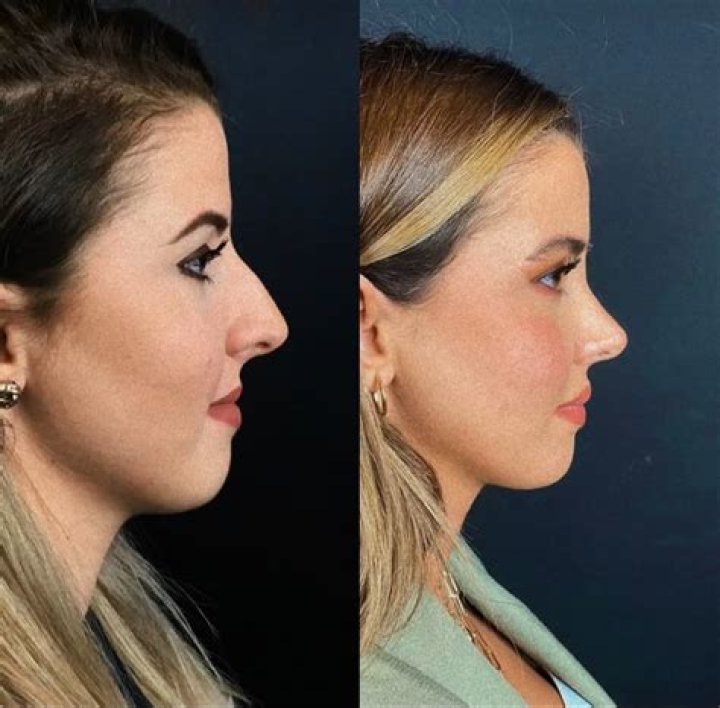 Lele Pons Nose Transformation: Get to Know Everything from Our Side!