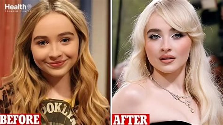 Sabrina Carpenter Plastic Surgery: Breast Augmentations, Lip Fillers, or Glowing Naturally?