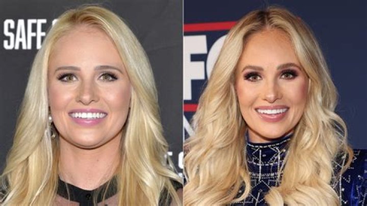Tomi Lahren Plastic Surgery: Did She Undergo Plastic Surgery?